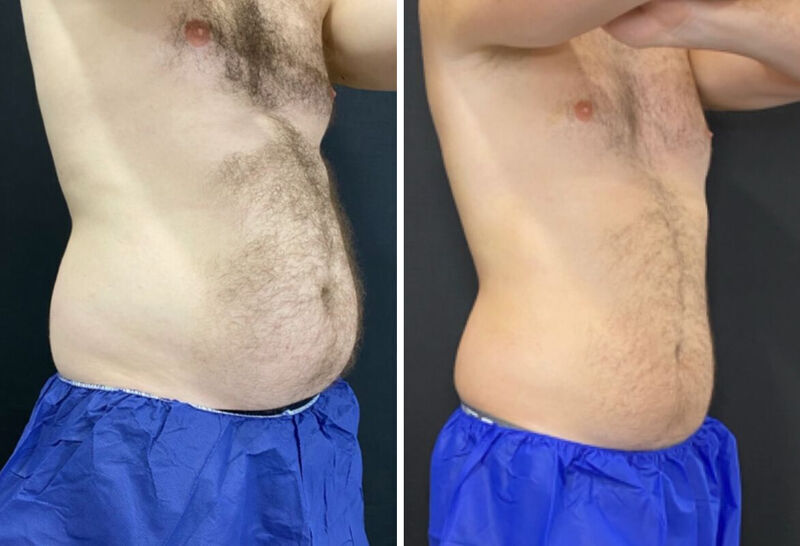 CoolSculpting Before & After Photo