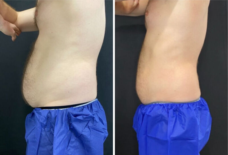 CoolSculpting Before & After Photo