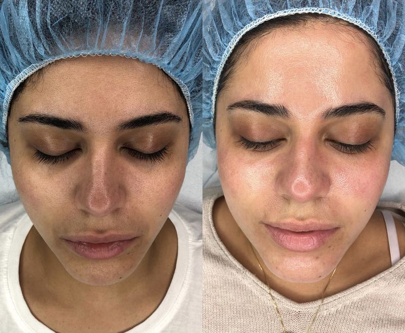 Dermaplaning Before & After Photo