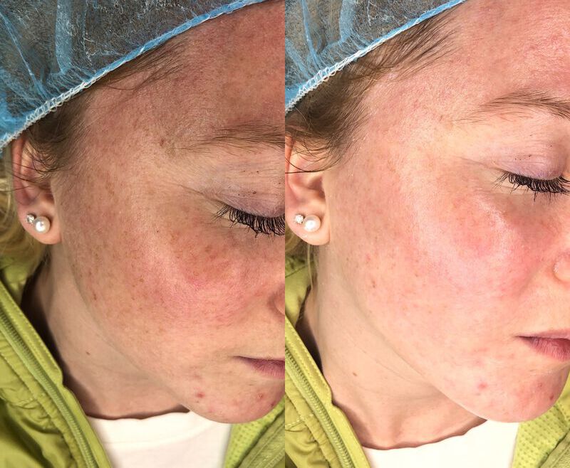 Dermaplaning Before & After Case 02 | Boston Medical Aesthetics
