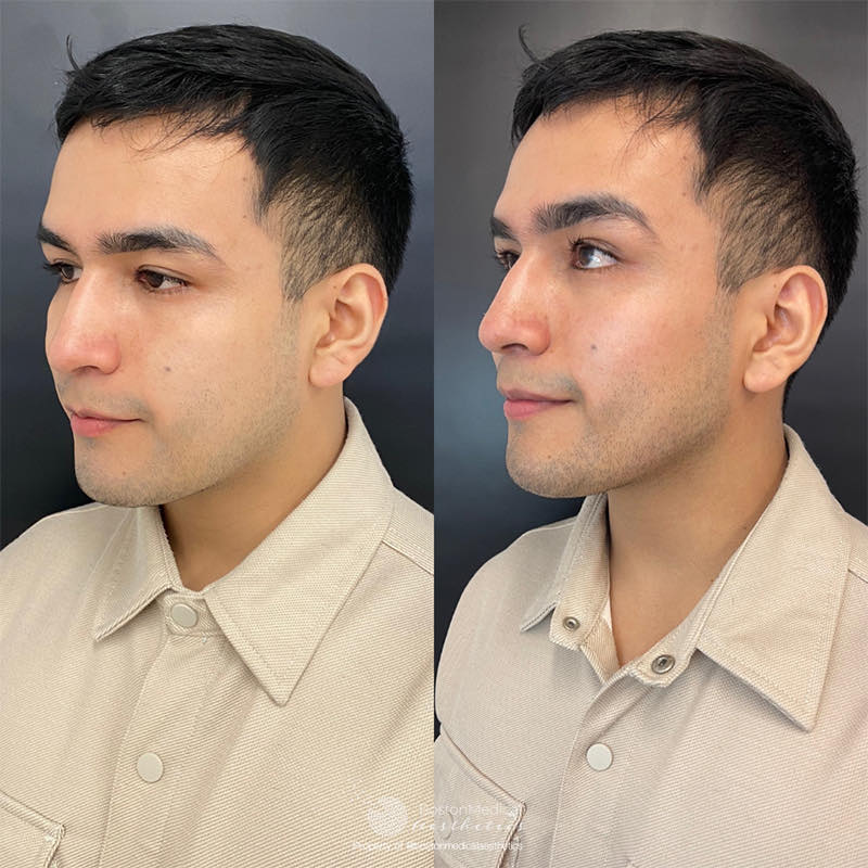 Facial Balancing Before & After Photo