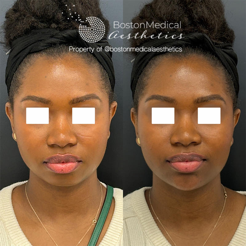 Facial Balancing Before & After Photo