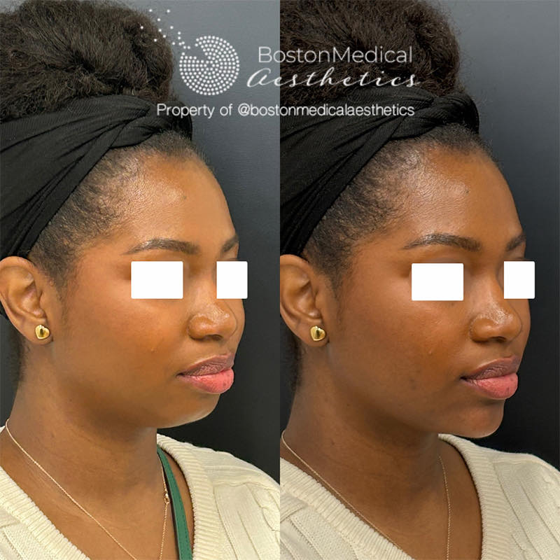 Facial Balancing Before & After Photo