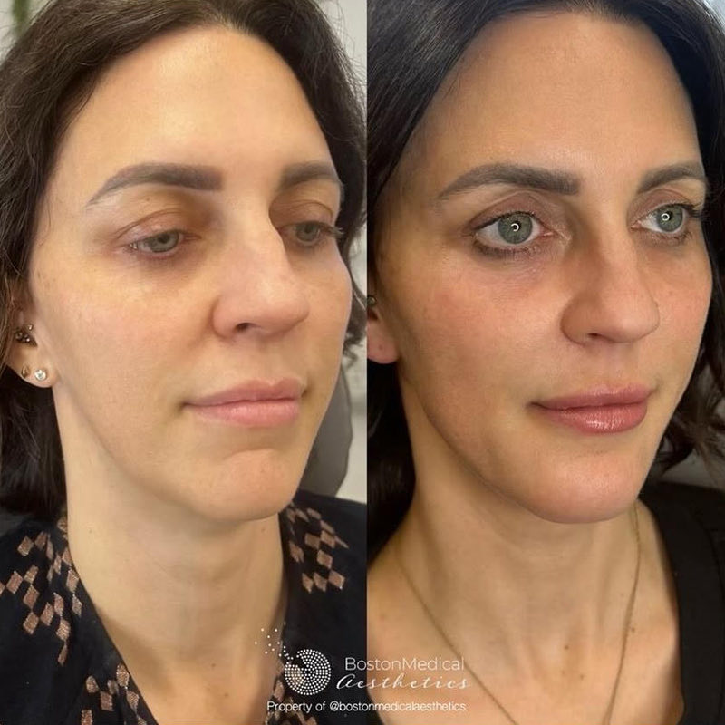 Facial Balancing Before & After Photo