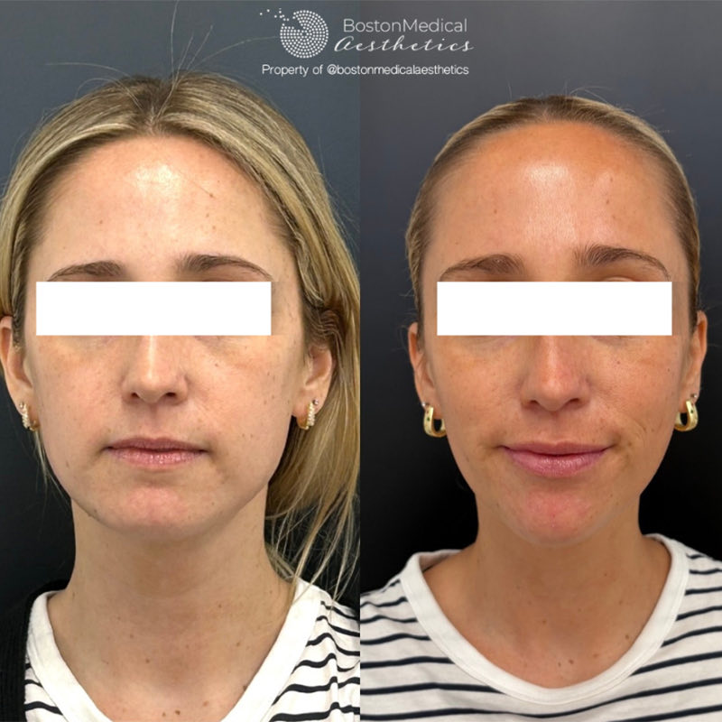Facial Balancing Before & After Photo