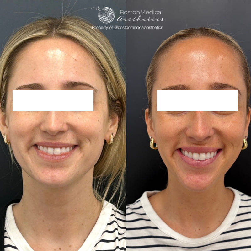 Facial Balancing Before & After Photo