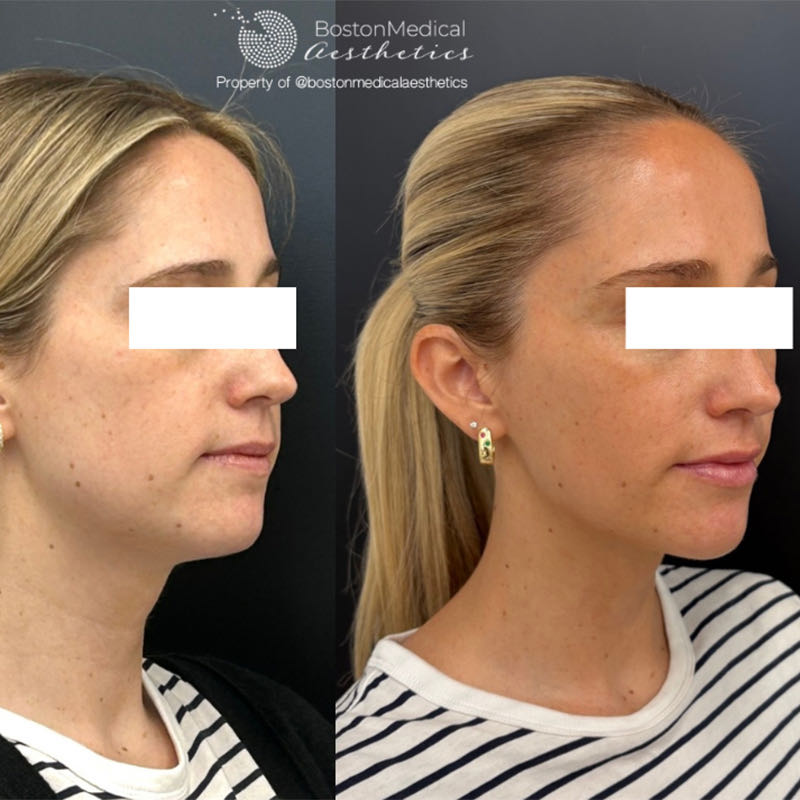 Facial Balancing Before & After Photo