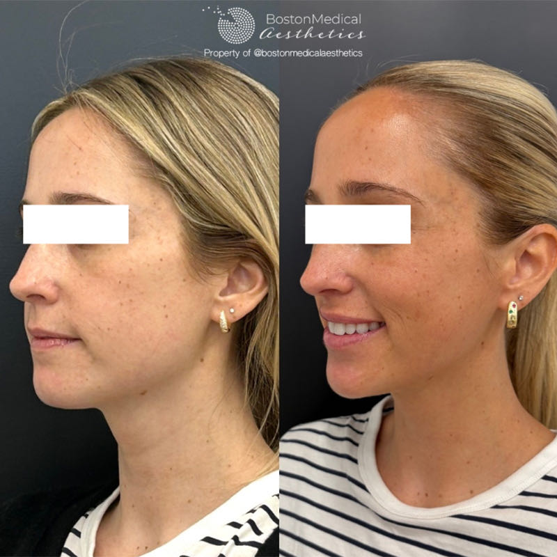Facial Balancing Before & After Photo
