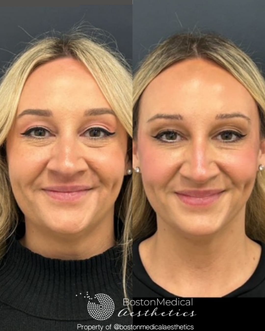 Facial Balancing Before & After Photo