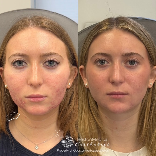 Facial Balancing Before & After Photo