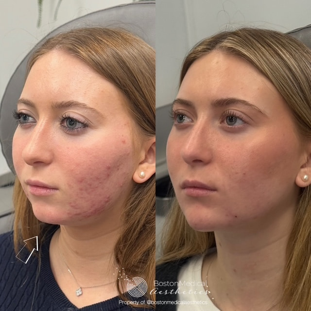 Facial Balancing Before & After Photo
