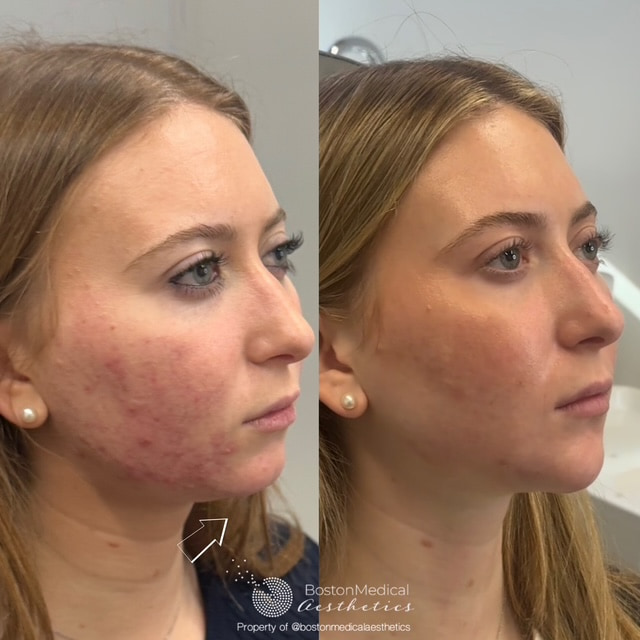 Facial Balancing Before & After Photo