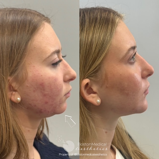 Facial Balancing Before & After Photo