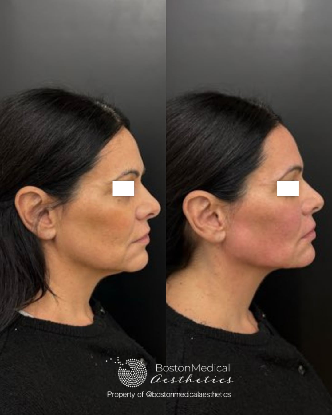 Facial Balancing Before & After Photo