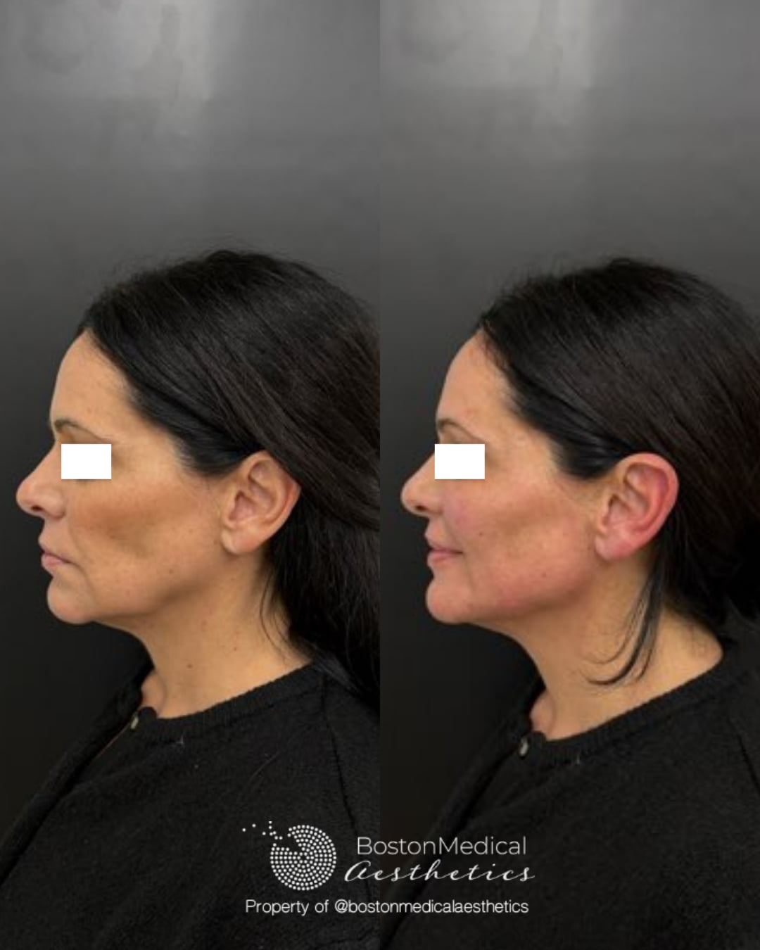 Facial Balancing Before & After Photo