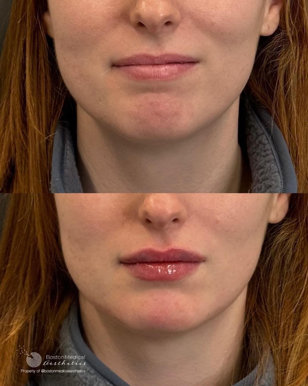 Facial Balancing Before & After Photo