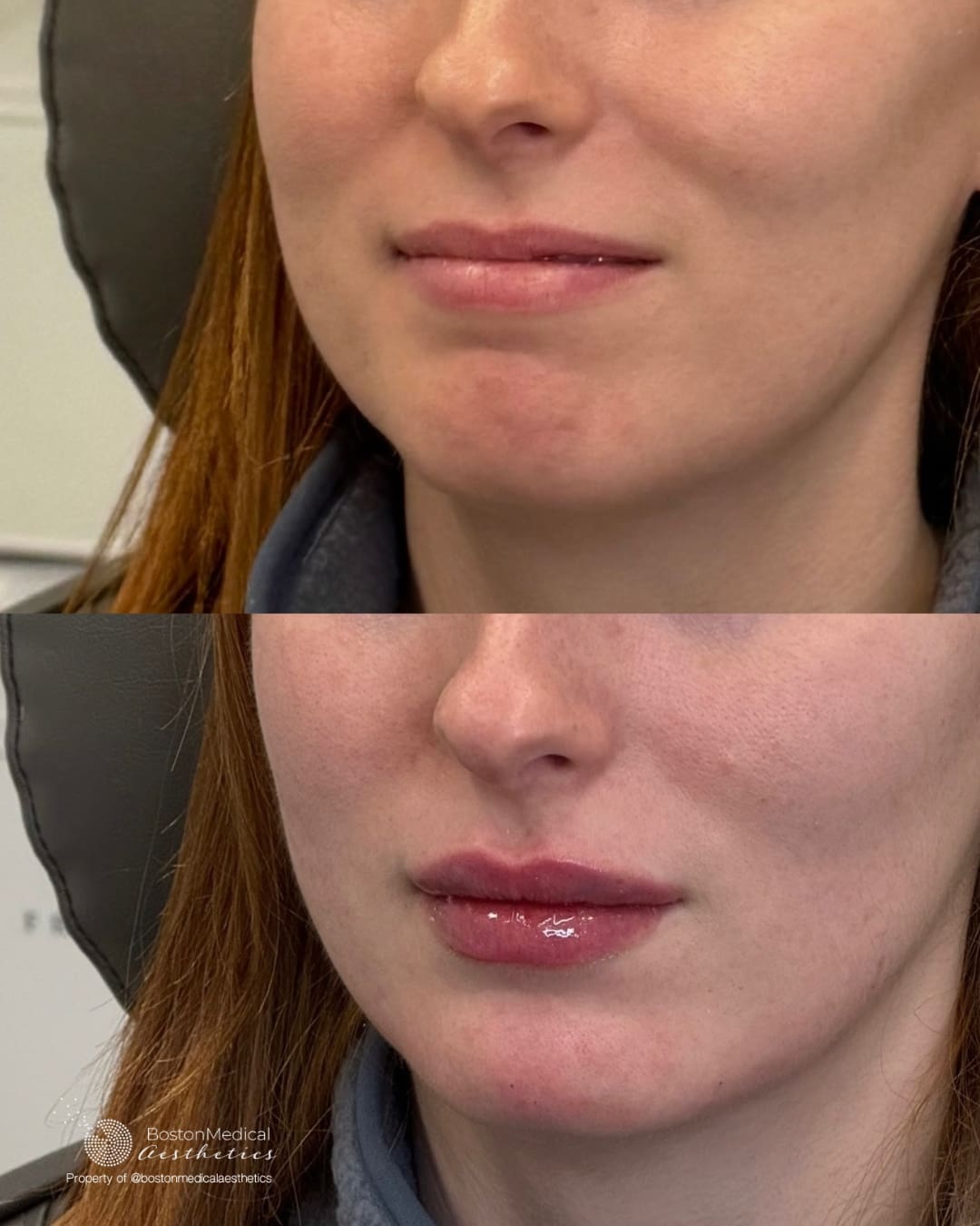 Facial Balancing Before & After Photo