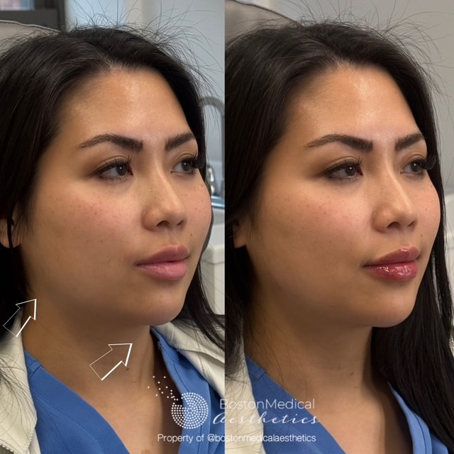 Facial Balancing Before & After Photo