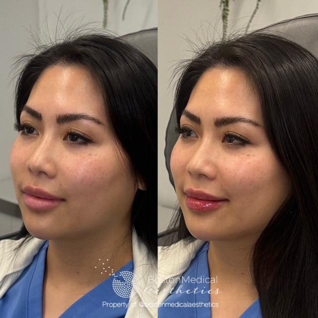 Facial Balancing Before & After Photo