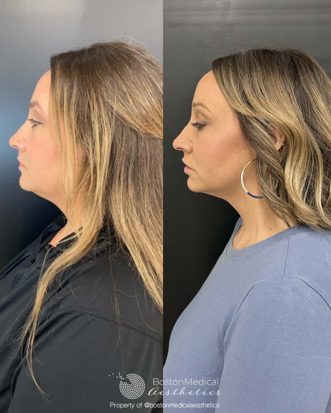 Facial Balancing Before & After Photo
