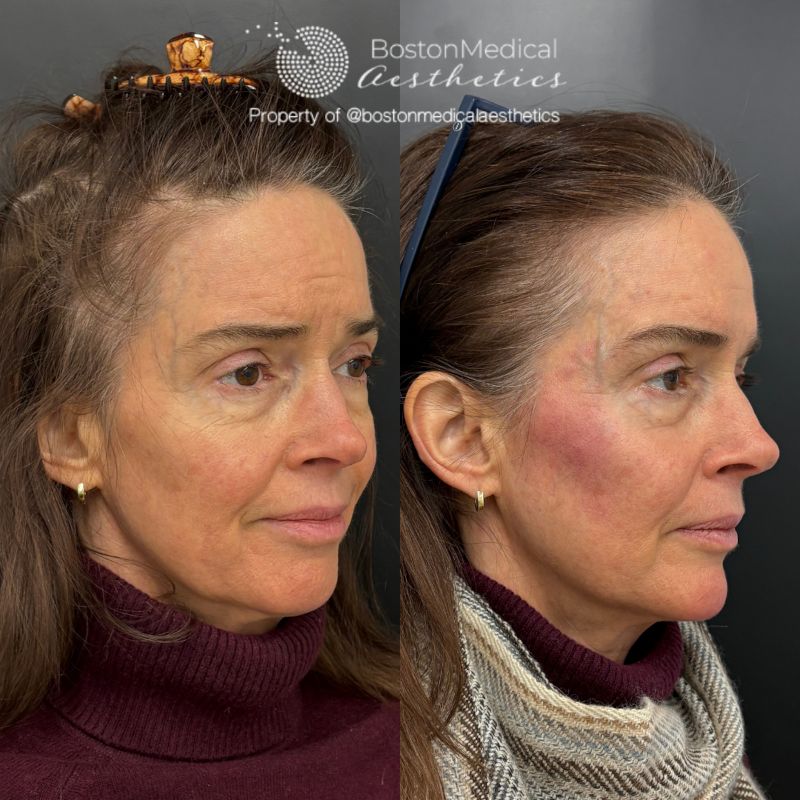 Facial Balancing Before & After Photo