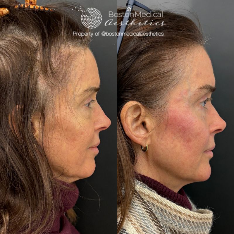 Facial Balancing Before & After Photo
