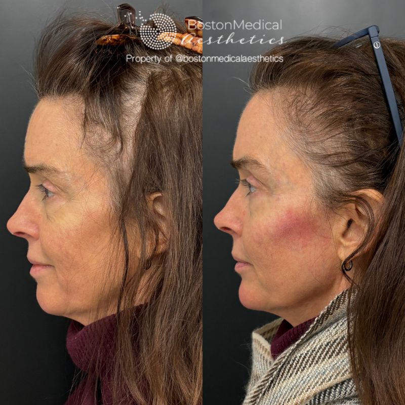 Facial Balancing Before & After Photo