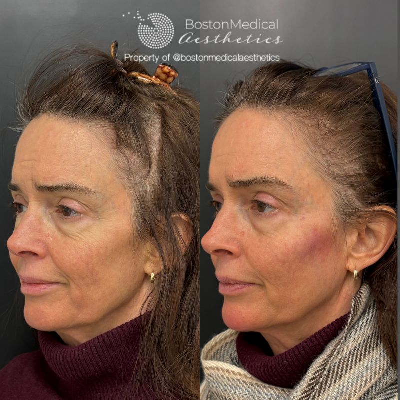 Facial Balancing Before & After Photo