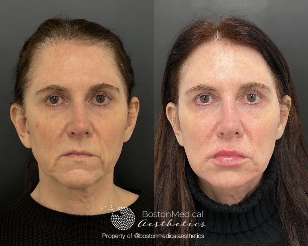 Facial Balancing Before & After Photo