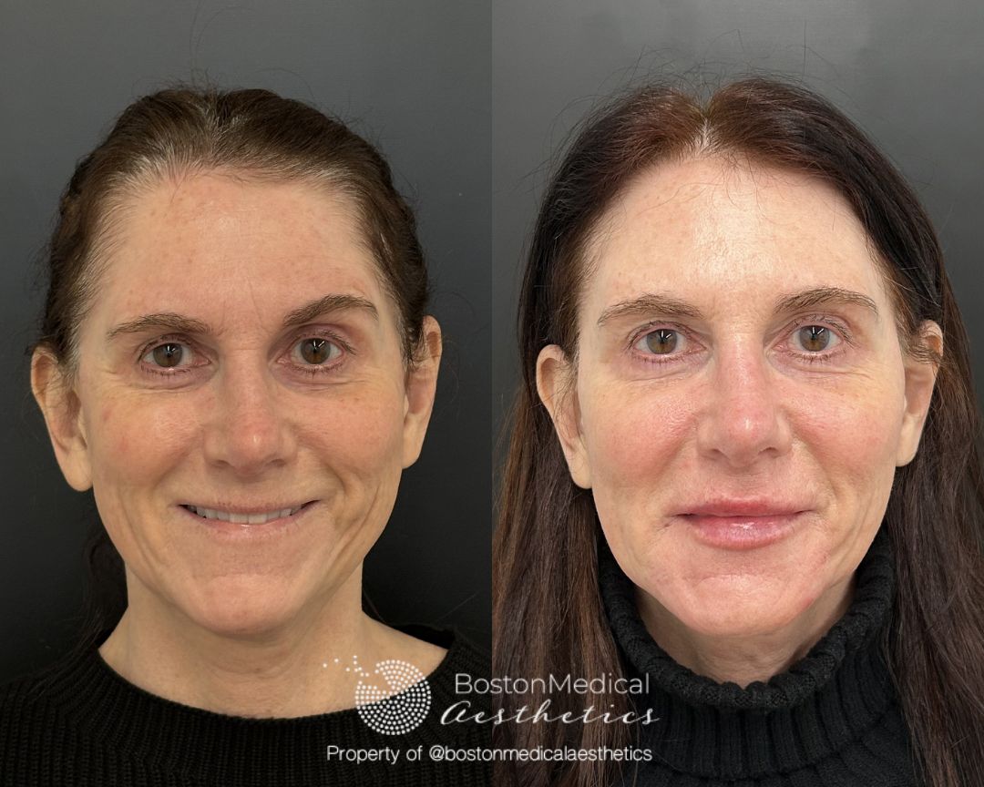 Facial Balancing Before & After Photo