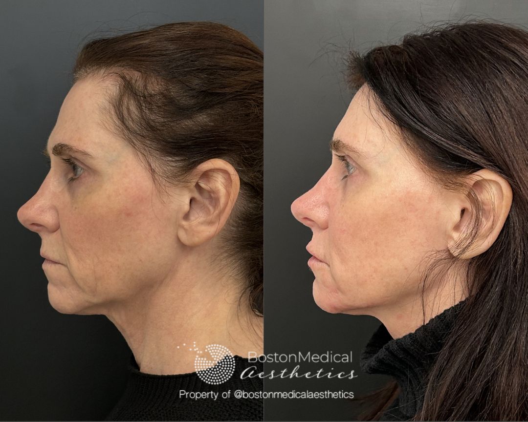 Facial Balancing Before & After Photo