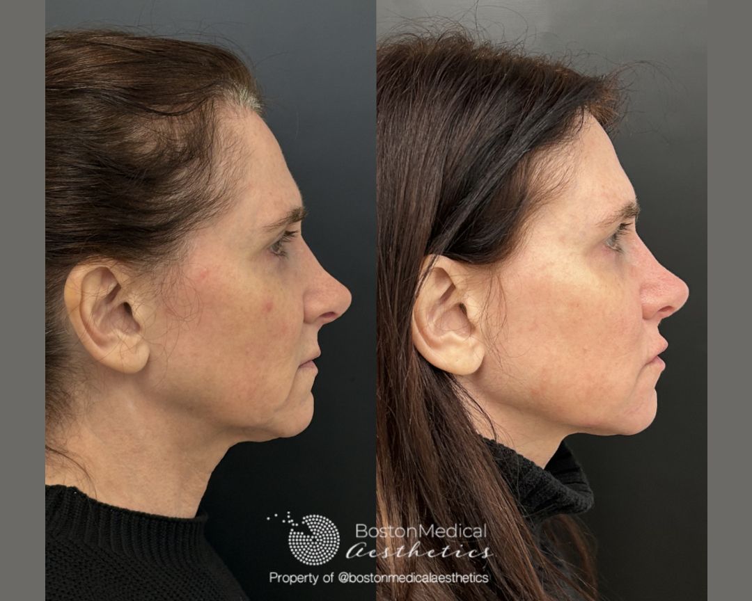 Facial Balancing Before & After Photo