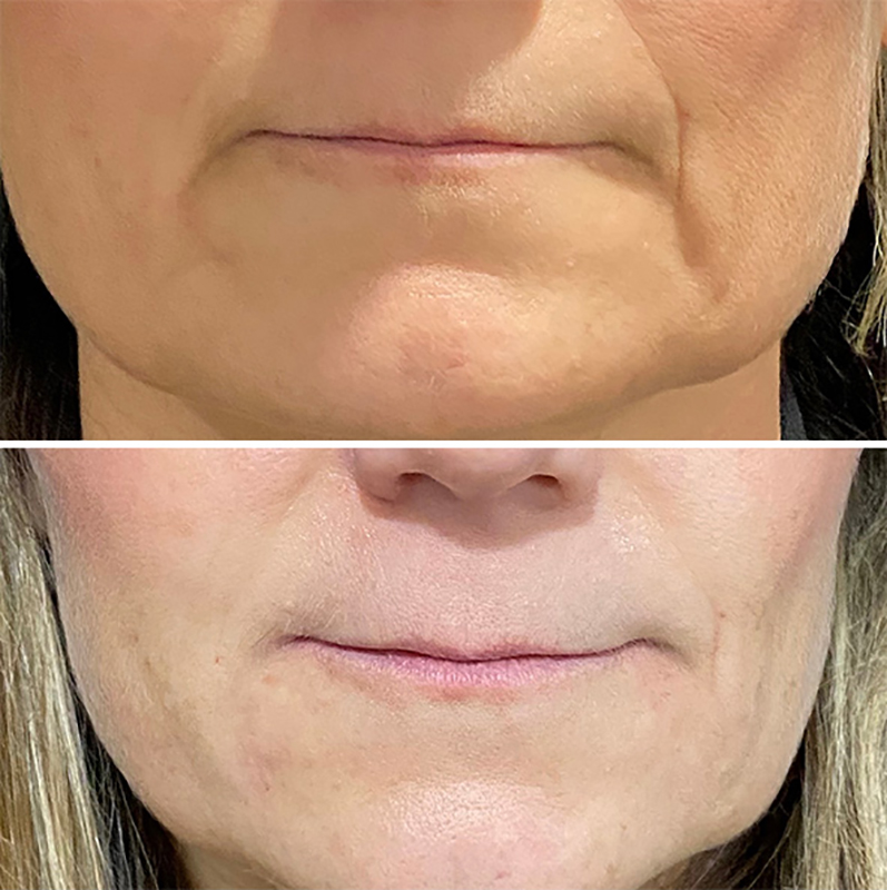 Facial Fillers Before & After Photo