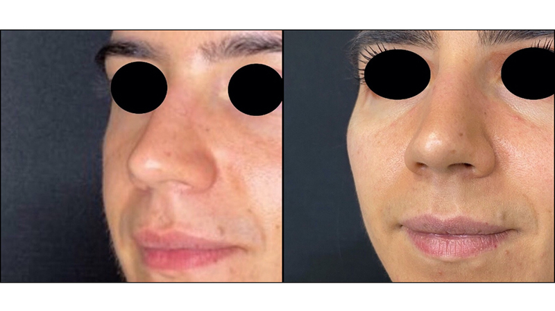 Facial Fillers Before & After Photo