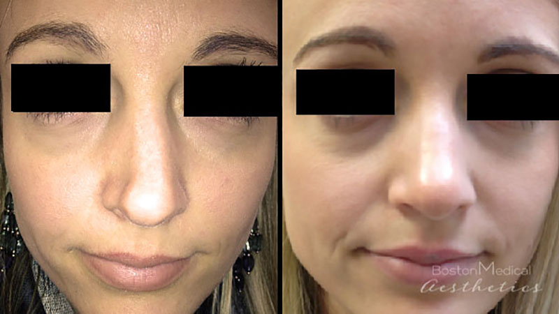 Facial Fillers Before & After Photo