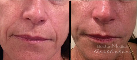 Facial Fillers Before & After Photo