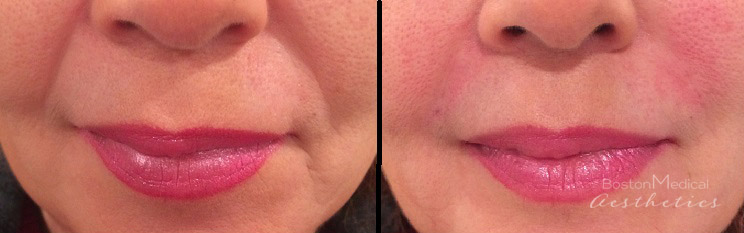 Facial Fillers Before & After Photo