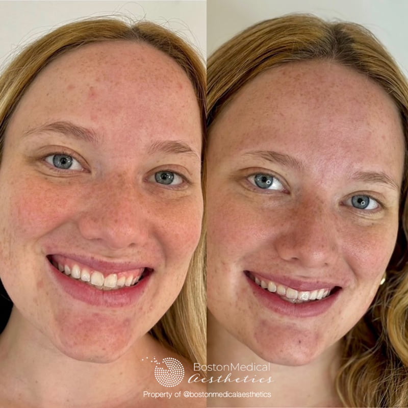 Gummy Smile Before & After Photo
