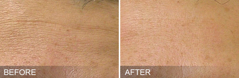 Hydrafacial Before & After Photo