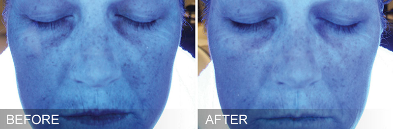 Hydrafacial Before & After Photo