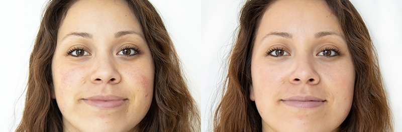 Hydrafacial Before & After Photo