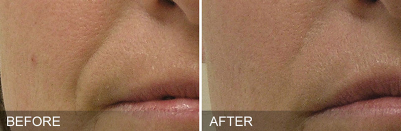 Hydrafacial Before & After Photo