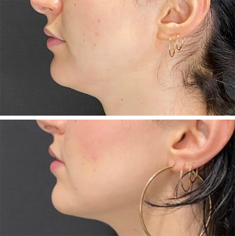 Kybella Before & After Photo