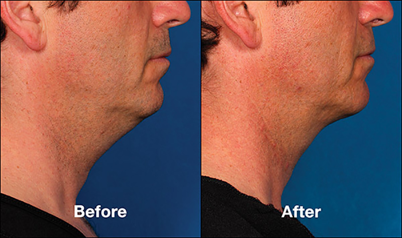 Kybella Before & After Photo