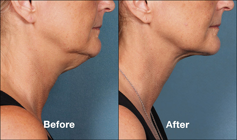 Kybella Before & After Photo