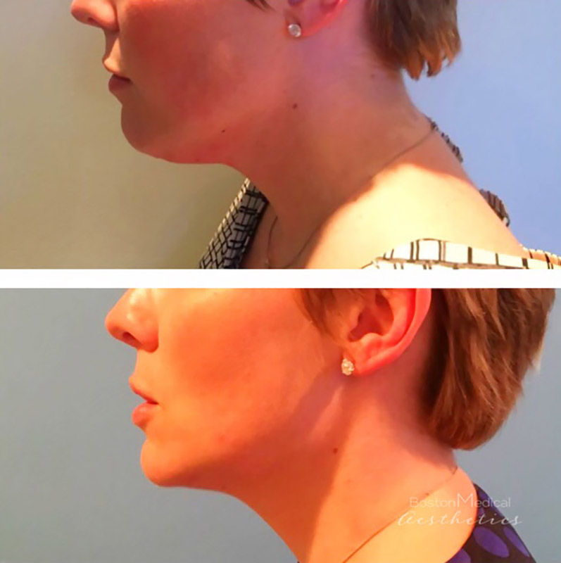 Kybella Before & After Photo