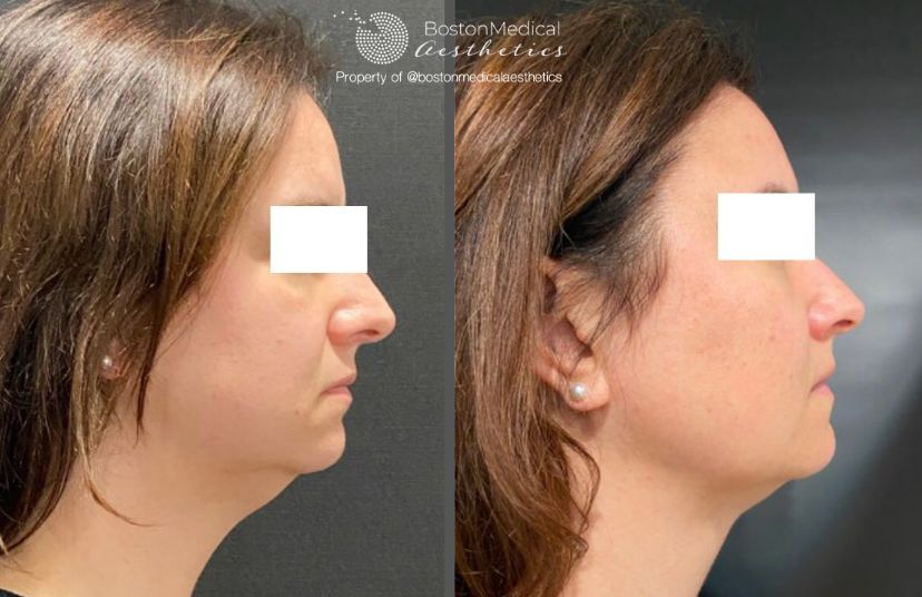 Kybella Before & After Image