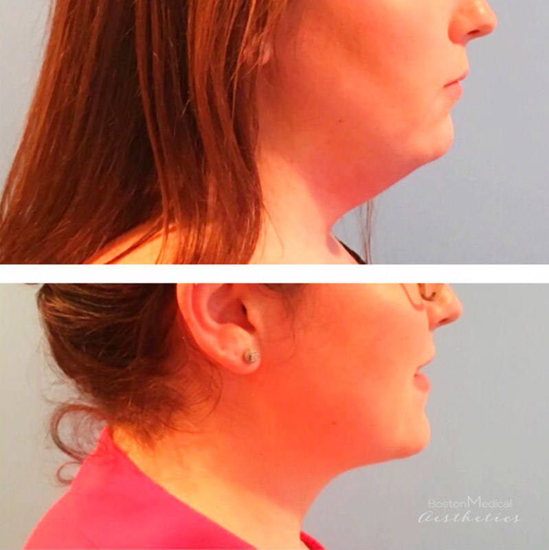Kybella Before & After Image