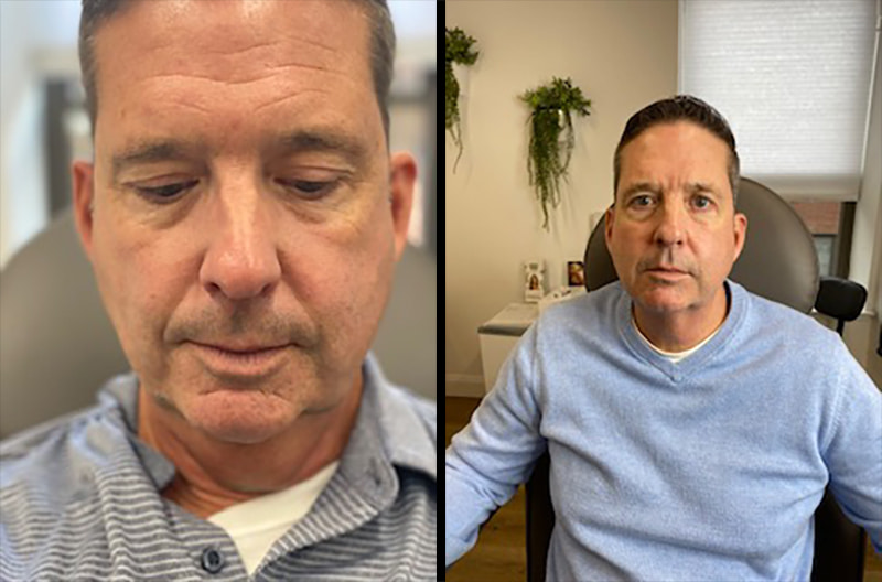 Kybella Before & After Image