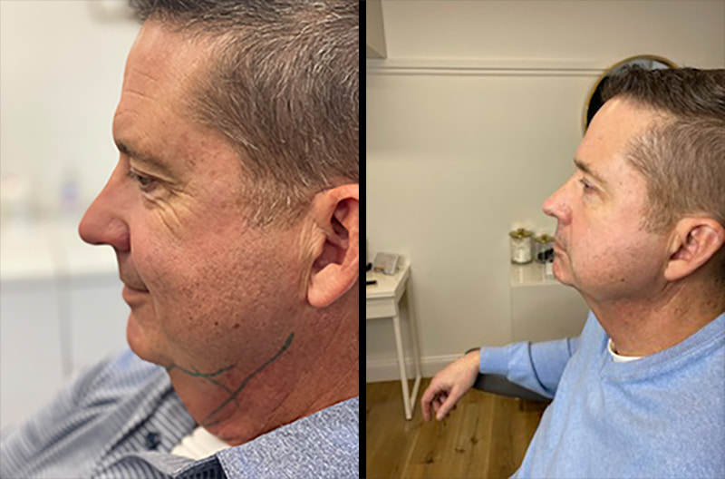 Kybella Before & After Image